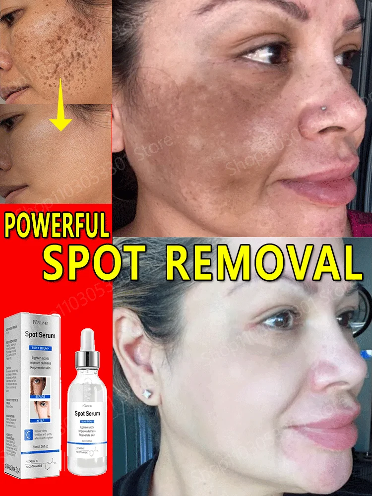 

Quickly Freckle Removal Improve Freckle Dark Spots Sun Melasma Remove Age Spots Lightening Melanin Whitening Facial Skin Care