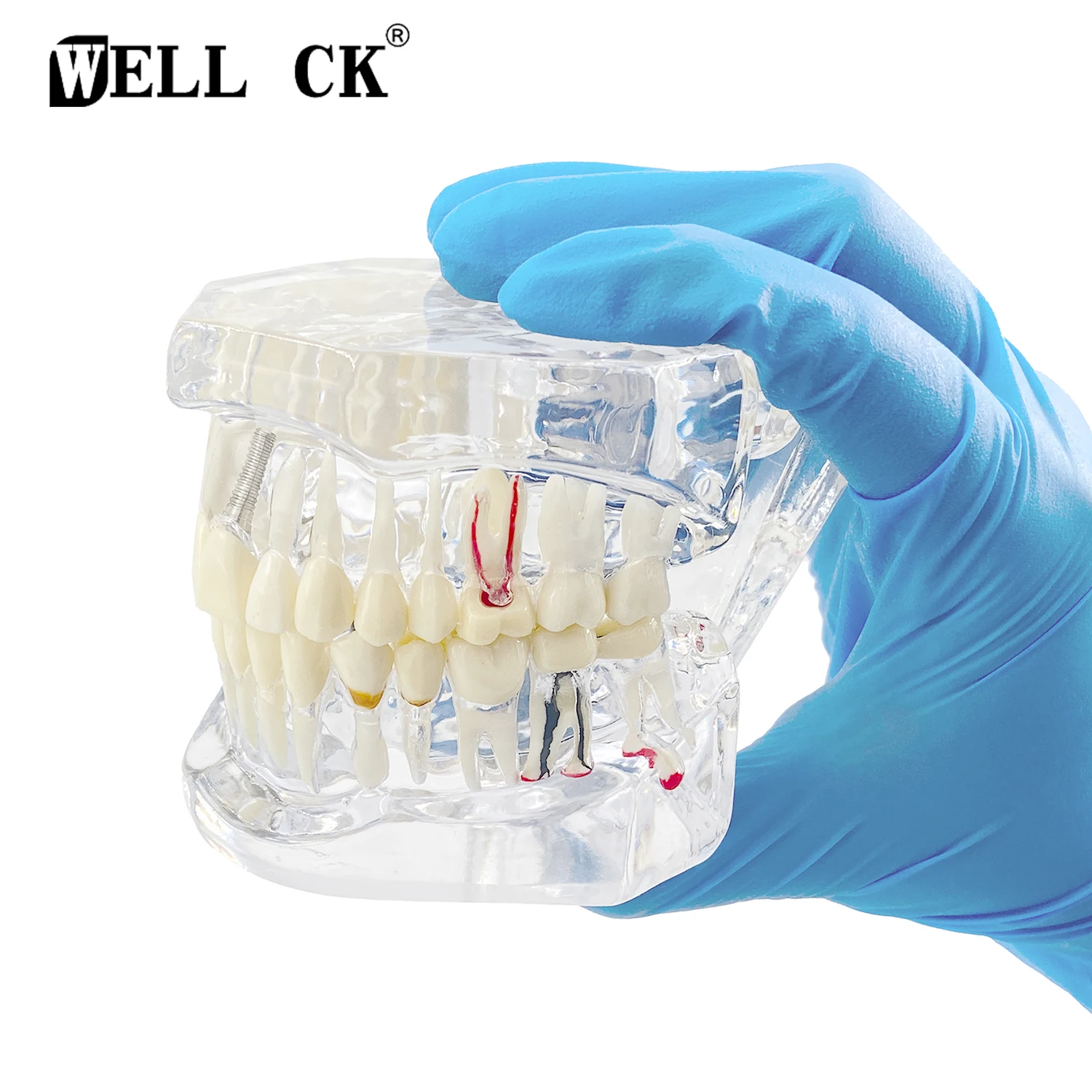 Disease Teeth Model With Restoration Bridge Tooth Dentist For Medical Science Dental Disease Teaching Study Dental Implant