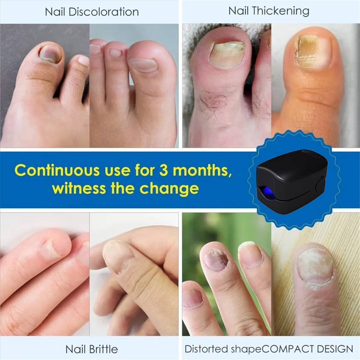 Lampu pembersih Fungu, perawatan Fung kuku untuk onychcoomysis sangat efektif untuk jari/kuku kaki C
