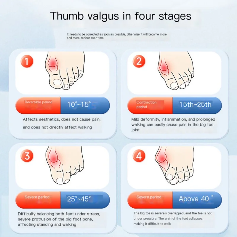 Hallux Anti-Valgus Brace，Bandage Fixed Support Toe Bone Rehabilitation Separator Factory Wholesale