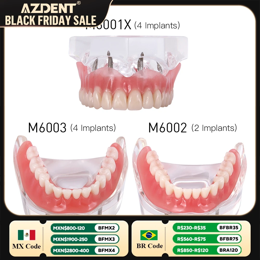 Dental Implant Teeth Model AZDENT Removable Interior Mandibular Demo Overdenture With Implants Upper Lower Tooth Teaching Study