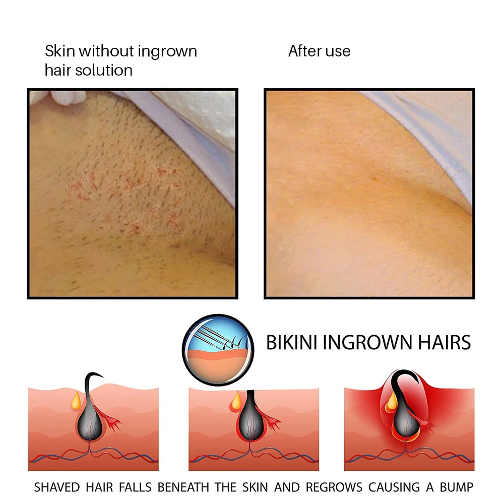 Prevent Ingrown Hairs Treatment After Shave Lotions blam for Men Repair Dark Spot Serum Reduce Redness Moisturizes Solution
