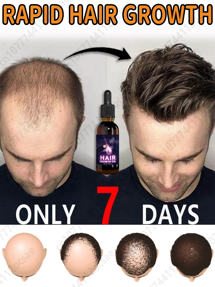 

30mI purpIe bottIe men's hair care essence 0iI, thick hair, get rid of baIdness