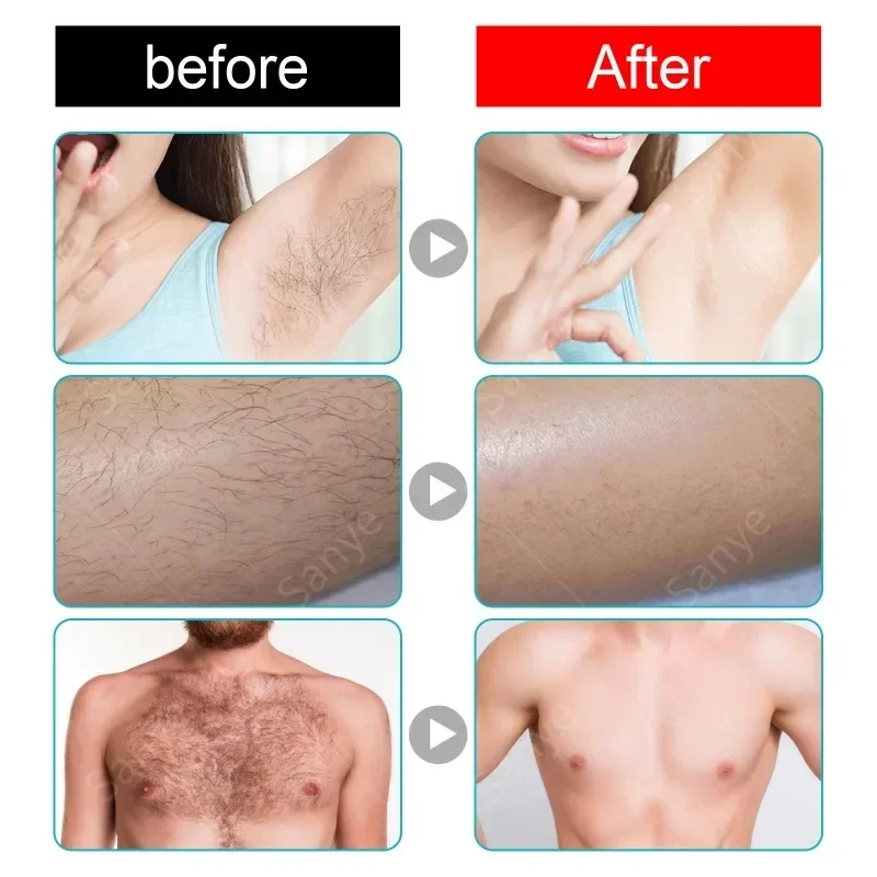 男性と女性のための永久的なボディ脱毛器,痛みのない脱毛セラム