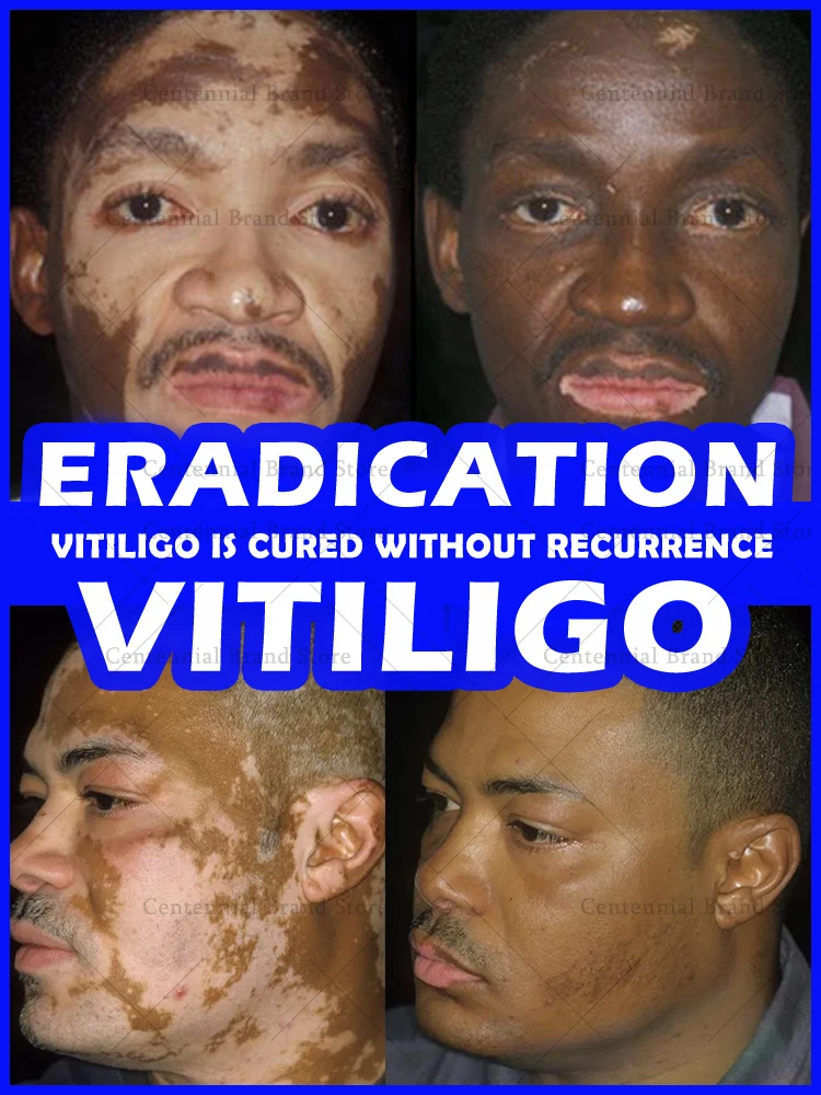 

Vitiligo ointment is effective in repairing the skin