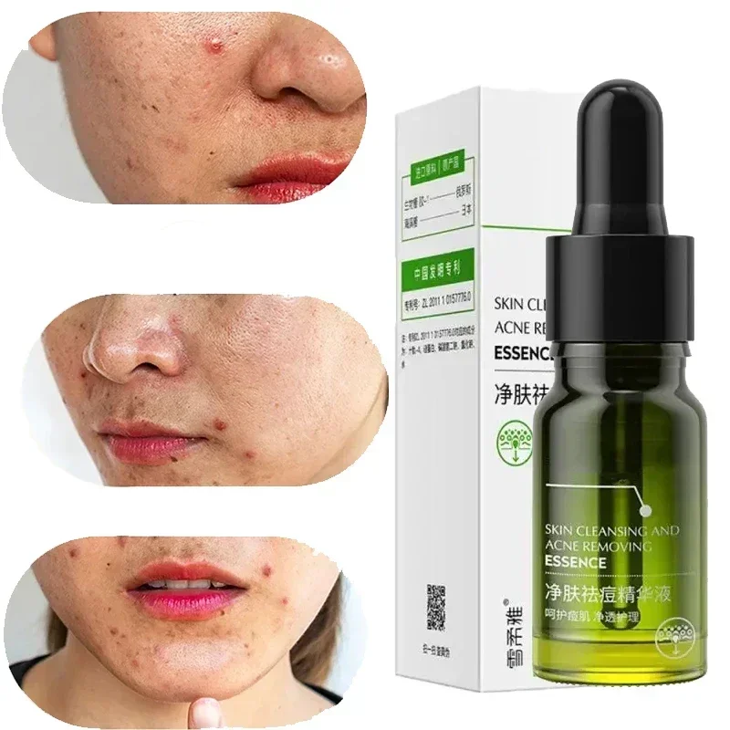 Effective Acne Removal Comfortable Acne-removing Liquid Improve Acne Convenient Facial Repair Solution Skin Care Products Gentle