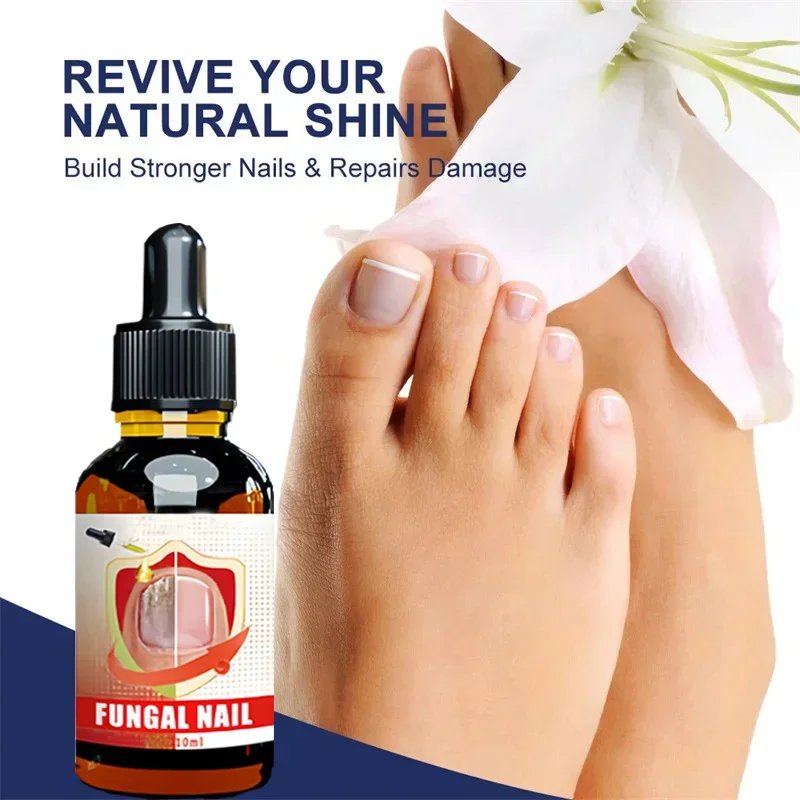 Fungal Nail Treatment Serum Foot Nail Fungus Removal Repair Gel Anti Infection Paronychia Onychomycosis Foot Nails Care Essence