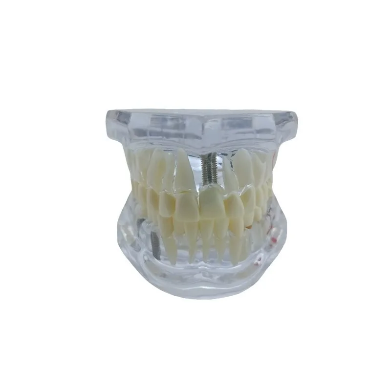 Restoration Model Stomatological Pathology, Doctor-Patient Communication Pathology Restoration Synthesis, Removable Dental Model