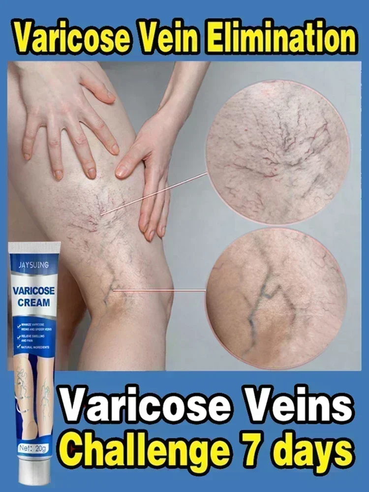 Varicose Vein Treatment Cream 20g Painless Removal Spider Vein Pain Varicosity Effective Varicose Healing Cream