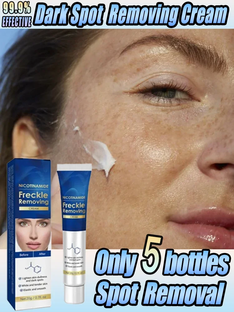 White ning Sommersprossen Creme wirksam entfernen Melasma Creme entfernen dunkle Flecken Melanin befeuchten aufhellen glatte Gesicht Hautpflege