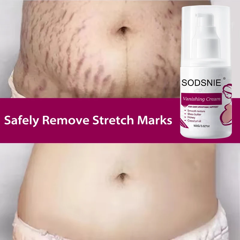 

100g Stretch Marks Permanent Removal Cream Eliminate Body Belly Stretch Marks Remove Skin Cracks Repair Firming Care