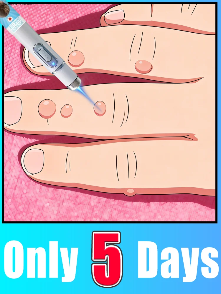 

Wart blue light tool Set Can says Goodbye ToFlat warts Filiform warts