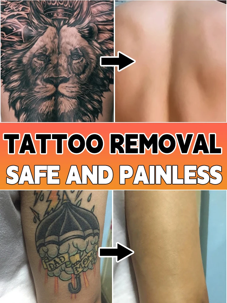 

Quickly fade tattoos/old tattoos, painless, irritation-free and safe repair