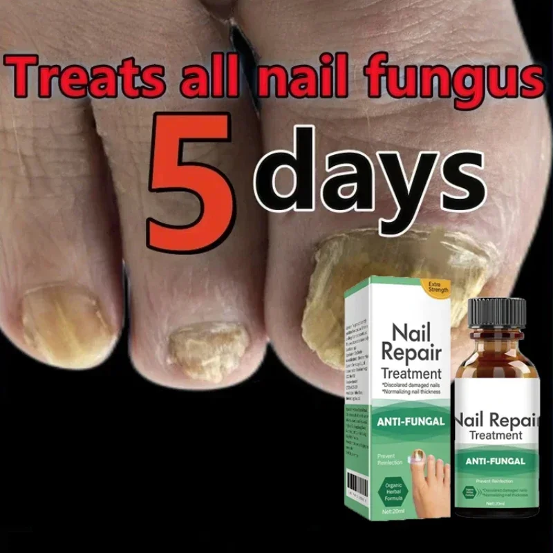 

Nail Fungal Treatment Feet Care Essence Nails Foot Repair Toe Nail Fungus Removal Oils Anti Infection Paronychia Onychomycosis