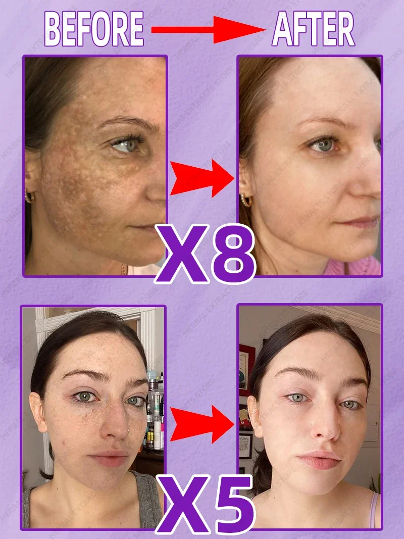 Piegi Melasma Sun Age Dark Spot