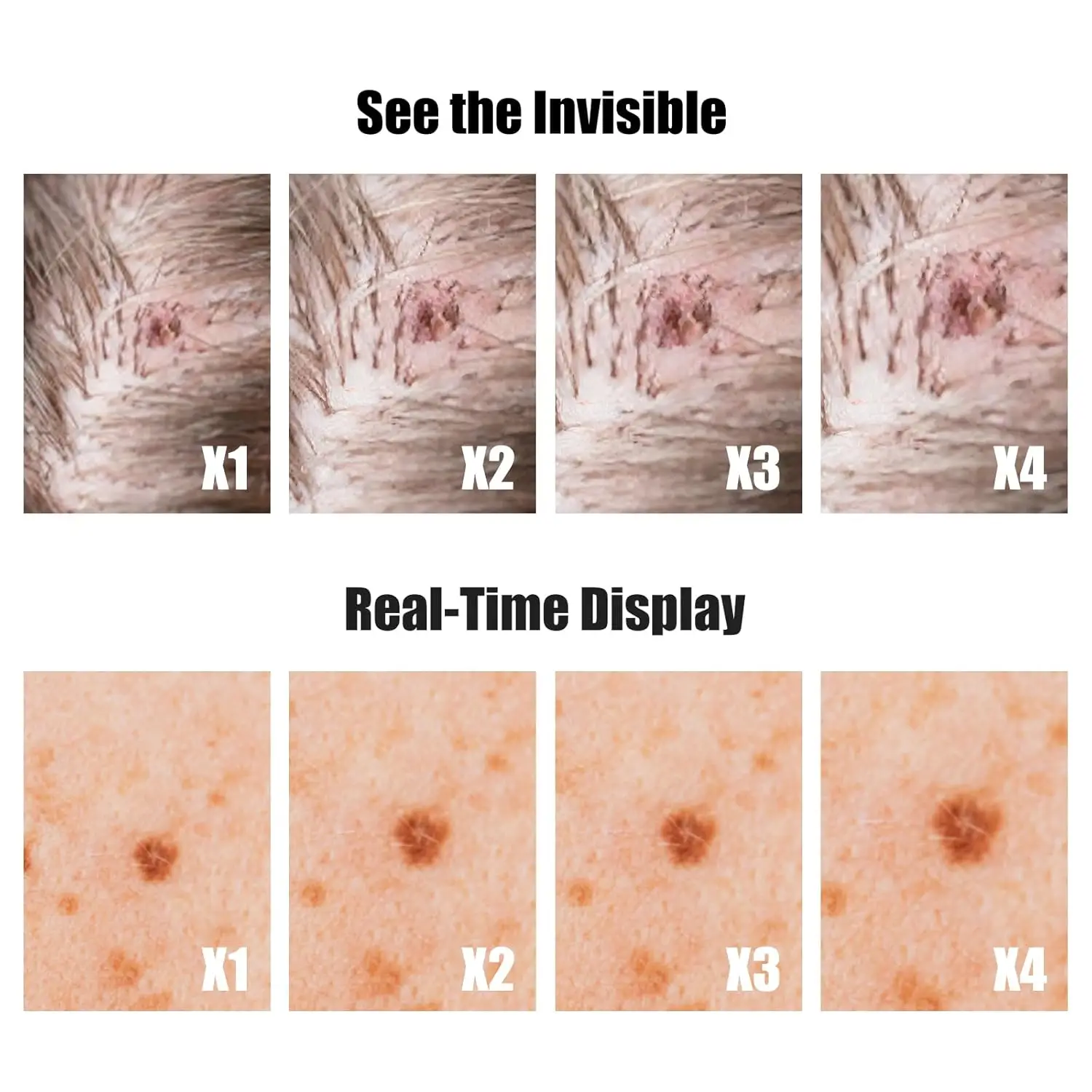 منظار الجلد المحمول مجهر رقمي مع شاشة 1080P IPS، مكبر 500X لفروة الرأس/الشعر تريكومز الوجه