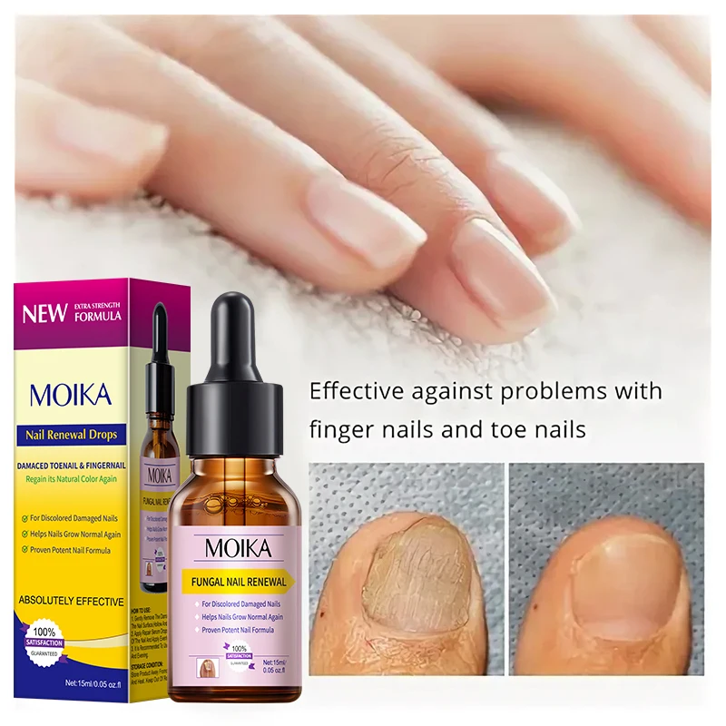 Suero de Tratamiento para Hongos en las Uñas de los Pies MOIKA, Gel Reparador para Eliminar Hongos en las Uñas, Anti Infección, Paroniquia, Onicomicosis, Cuidado de las Uñas de los Pies