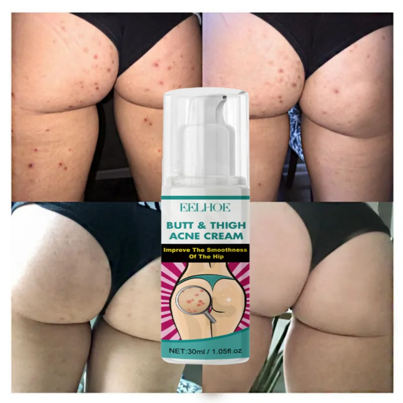 Effective Acne Treatment Cream Remove Acne Mark On Buttock Thigh Back Clear Face Dark Spot Pimples Zit Pore Clogging Body Lotion