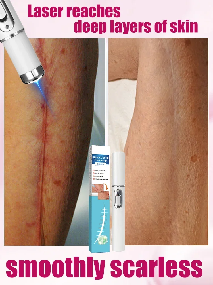 Powerful Laser Treatment for Moderate Long-Term Scars and Hypertrophic Scars