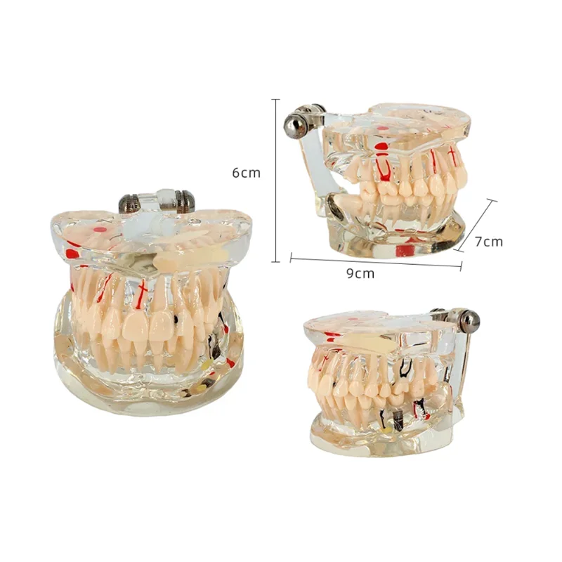 Dental Teeth Model For Studying Education Transparent Tooth Implant Model