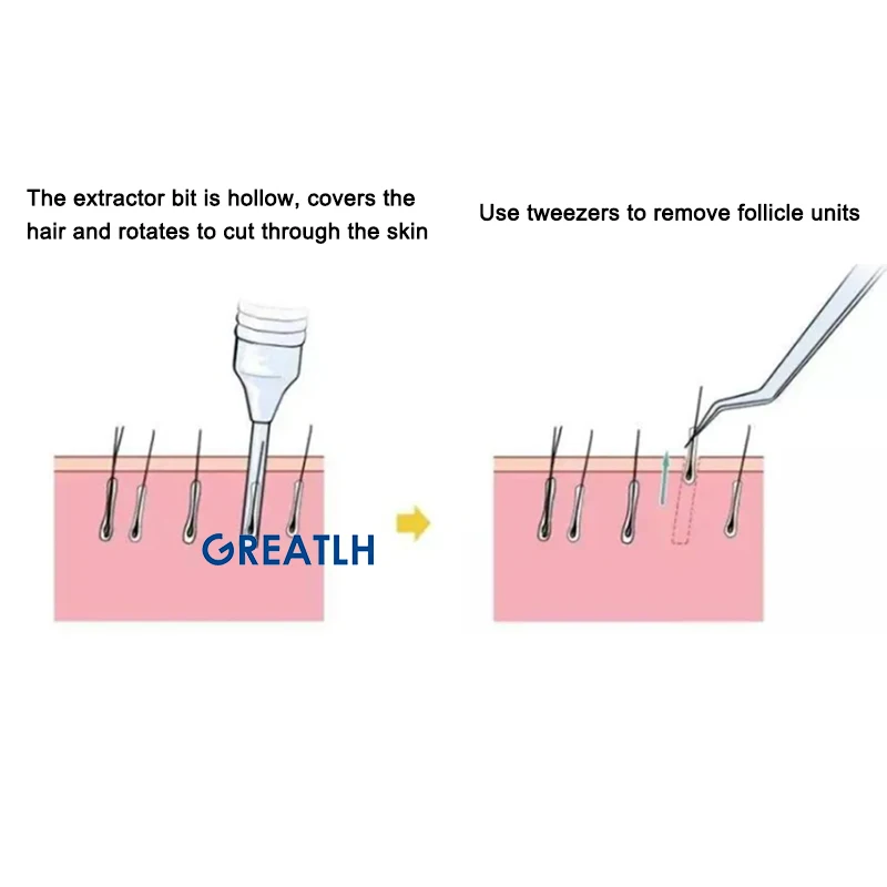 Greatlh-ステンレス鋼の髪の健康的なパンプス、以下の抽出ツール、髪のお母さんのための抽出器