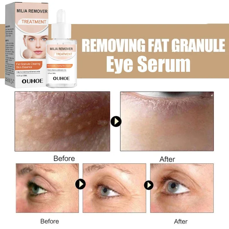 Fat Granules Removal Eye Serum Anti Dark Circle Eye Bags Fade Fine Line Essence Anti-Puffiness Moisturizing Skin Care Products