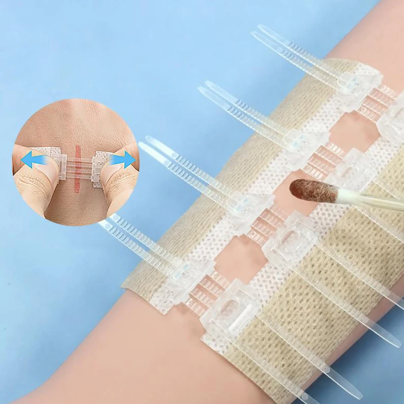 Zipper Tie Wound Closure Patch Hemostatic Patch Wound Fast Without Suture Zipper Outdoor Band-Aid Portable Quick Clot Wound