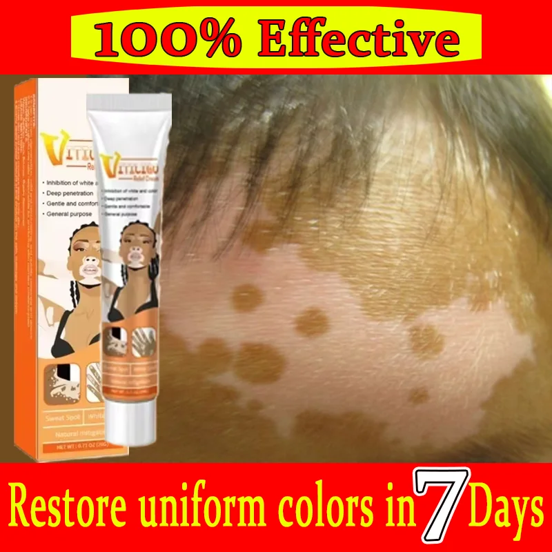 

Organic Vitiligo Treatment With Herbal Extract for White Spot Ringworm Removal