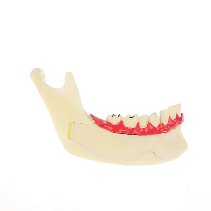 

New Dental Endodontic Model Anatomy Of Gums Mandible Tissue Anatomical Model Dentist Teach Study Demonstration Teeth Model