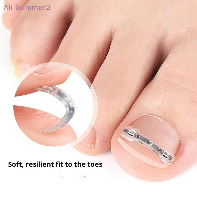 2個入り 13/15/17mm プロ仕様 巻き爪矯正クリップ ブレース 巻き爪矯正ツール 巻き爪治療