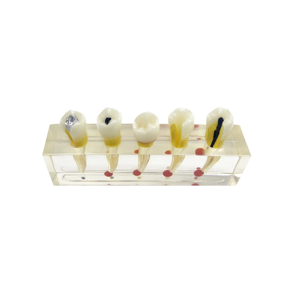 Dental Endodontic Clinical Model Transparent Caries Disease Anatomical Teeth Model For Studying Teaching Education Demonstration