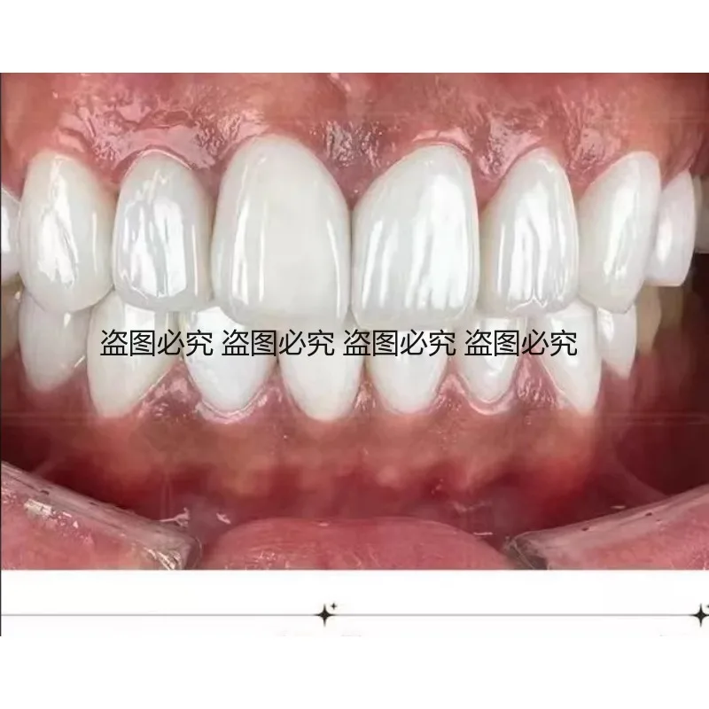 Resin Temporary False Teeth Removable Invisible Dentures Custom Snap on Teeth for Front Tooth Cover Comfortable for Daily Eating