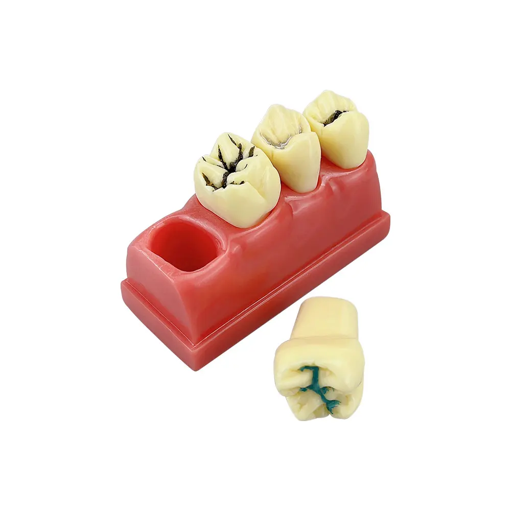 Teaching Training Model 4 times Pit And Fissure Sealant Model For Dentist Dental Clinics Studying Medical Science Oral Tools