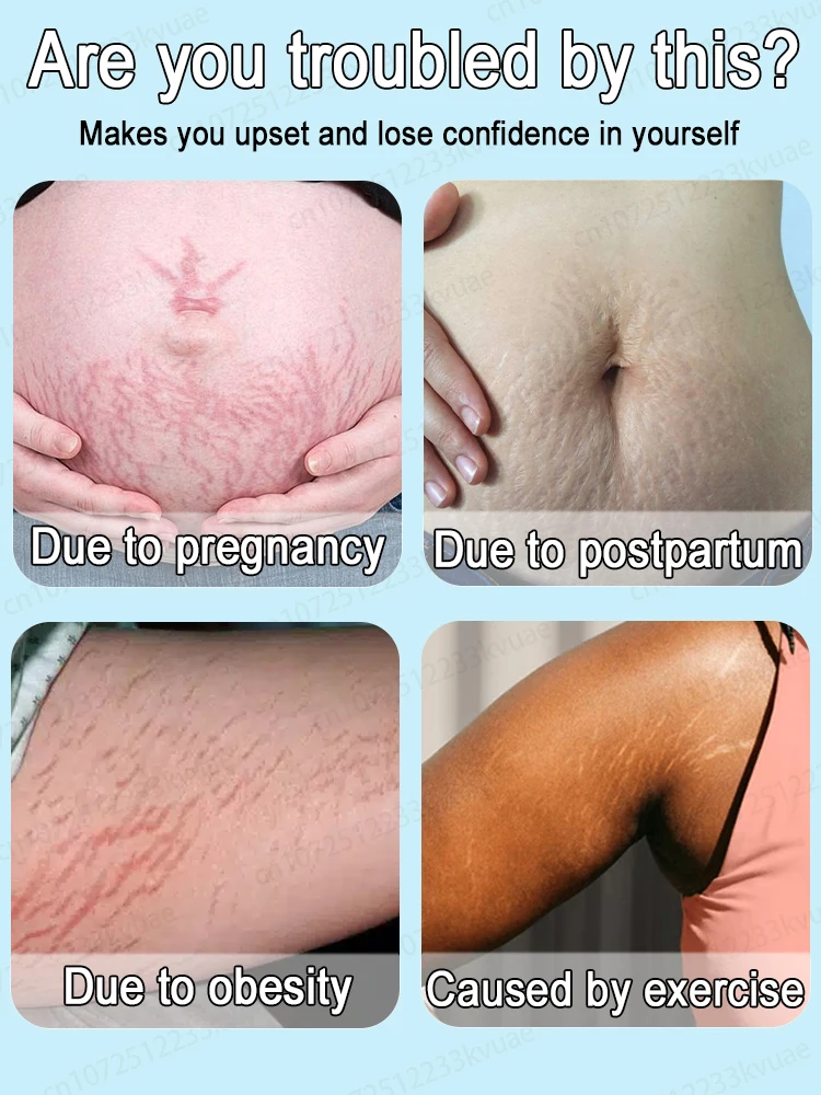 Entfernen Sie Dehnungsstreifen, berechnen Sie Streifen vor, beseitigen Sie sich, beseitigen Sie keine Narben in nur 7 Tagen