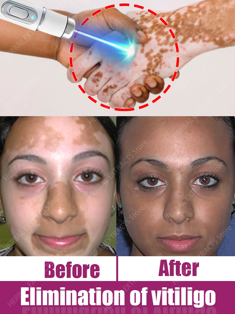 

Vitiligo быстро улучшает белые пятна