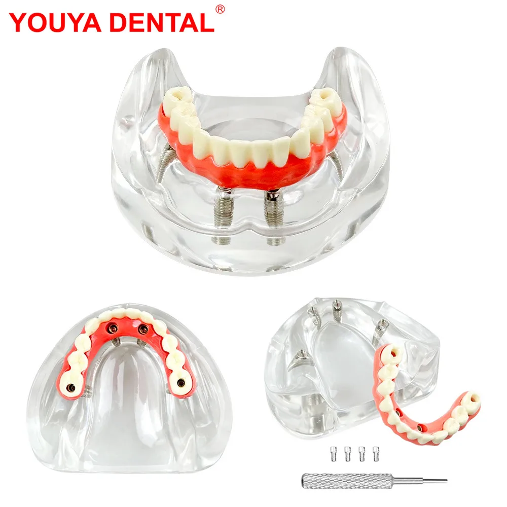 New Dental Implant Model 4 Implants Low Jaw Maryland Bridge Teeth Models Overdenture Restoration Typodont For Education Teaching