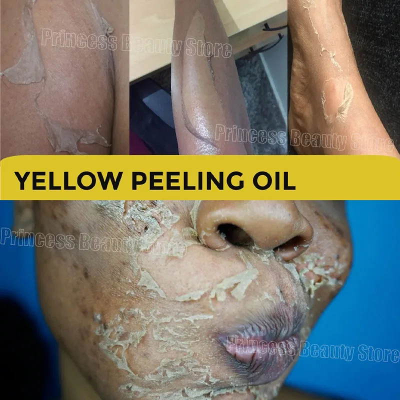 Yellow Peeling Oil 100% Organic Whitening Bleaching Dark Skin Serum Dark Knuckles Fast Whitening Body Care Korean Cosmetics