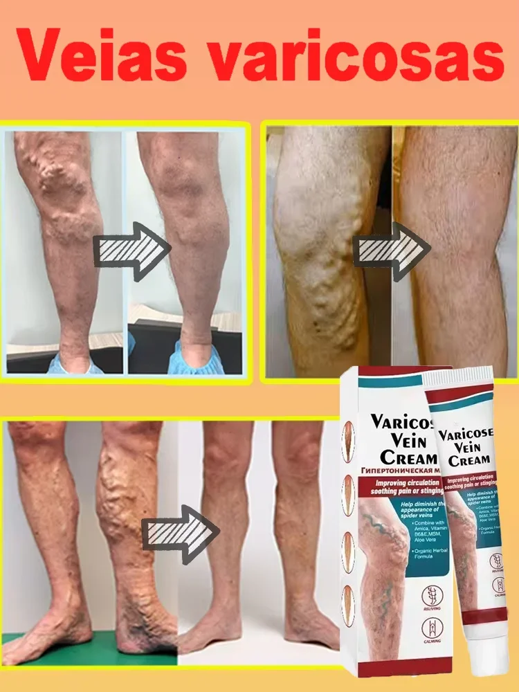 

Varicose Veins Relief Leg Vasculitis Phlebitis Spider Shape Vein Pain Relief Ointment Angiitis Removal Body Care Massage