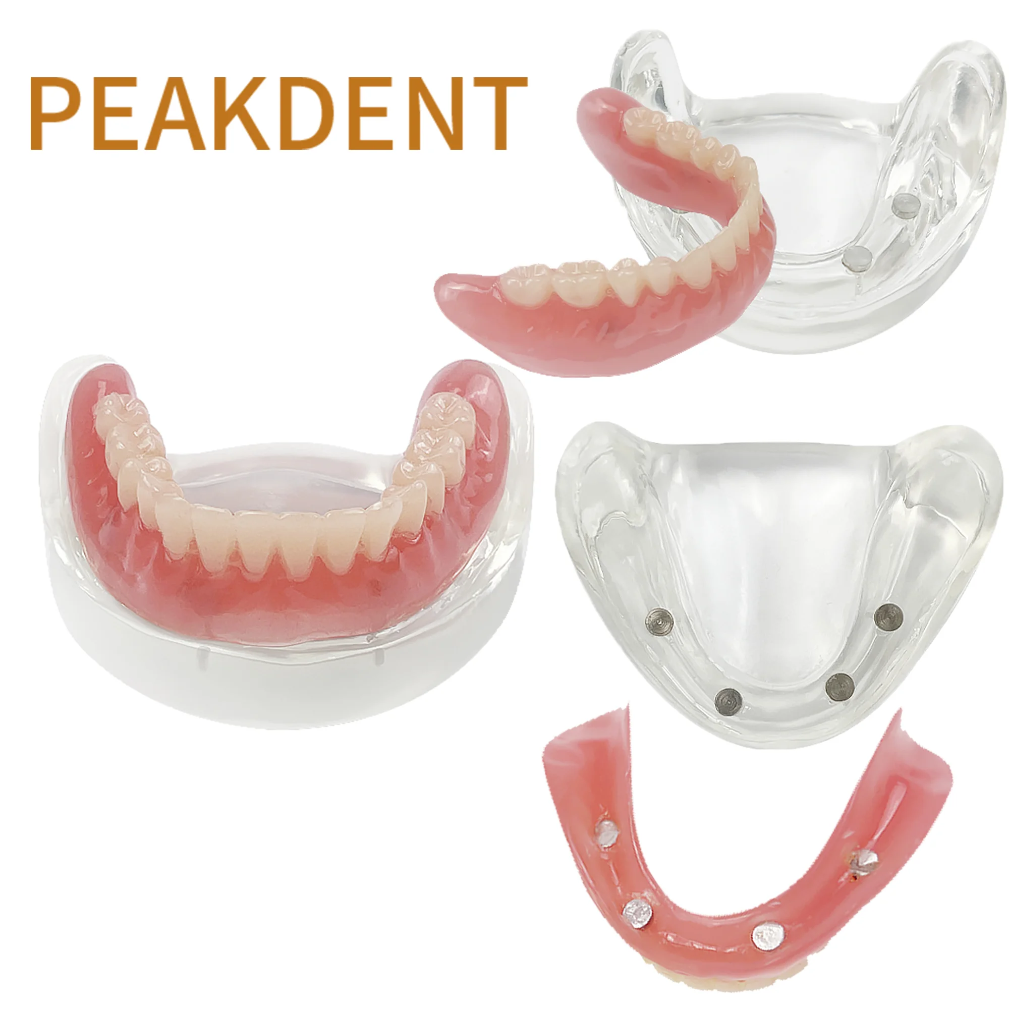 Removable Lower Jaw Implant Practice Model Dental Overdenture Teeth Model for Removable Implant Model For Dentist Communication