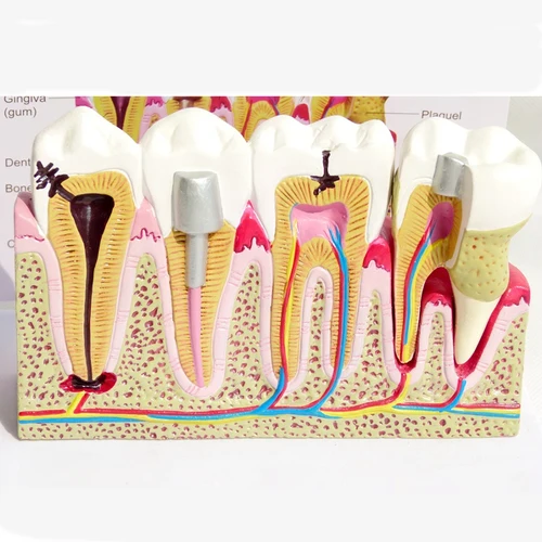 Imagen 1 del producto Modelo de dientes de caries de anatomía Dental, aparatos dentales extraíbles, enseñanza de anatomía y estructura de dientes enfermedades, herramienta de odontología