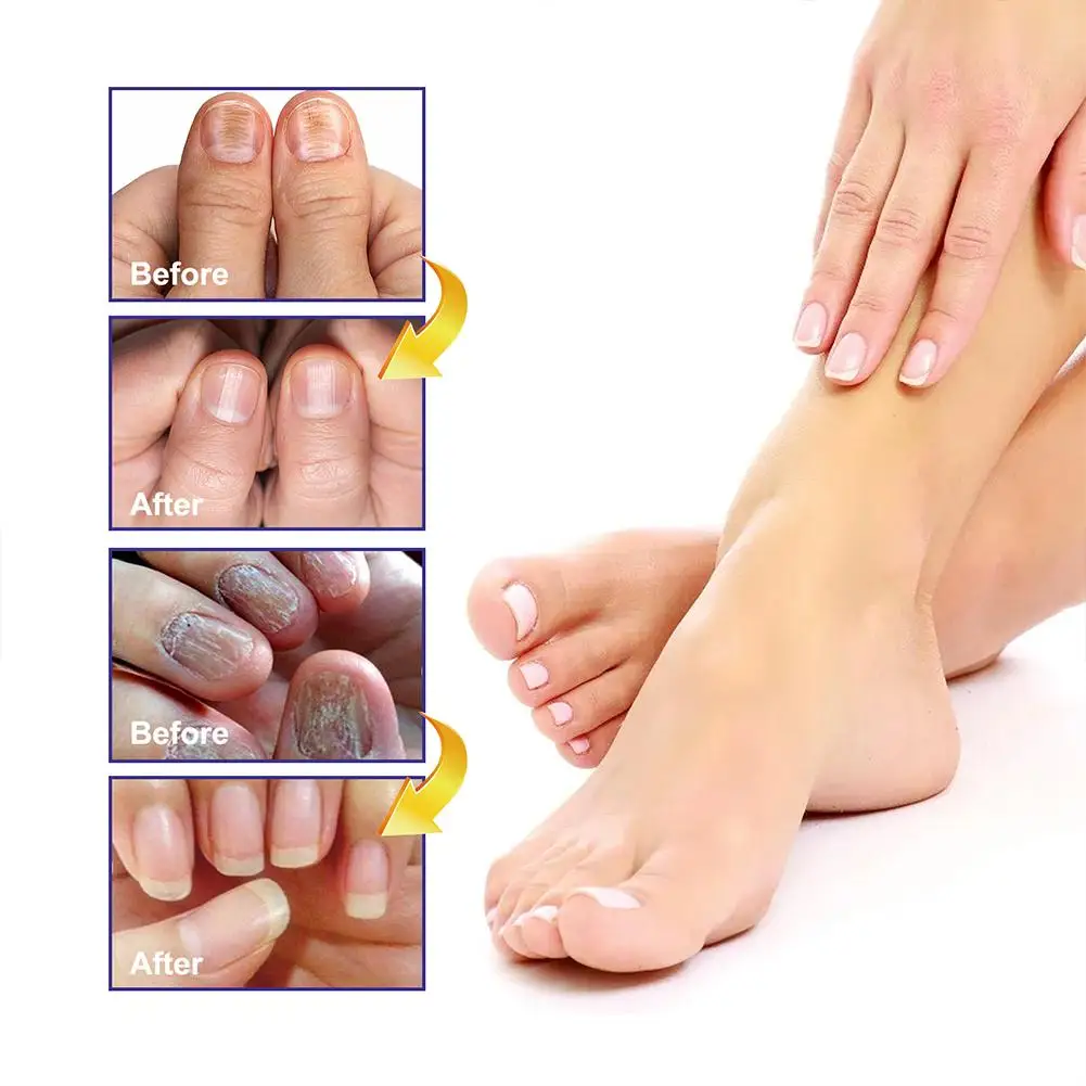 1PCS Nail Fungal Treatment Feet Care Essence Anti Infection Repair Fungus Toe Removal Paronychia Serum Fungal Nail Onychomy R5L2