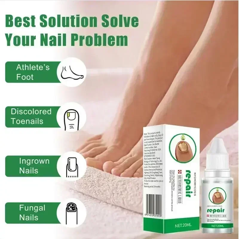 Nail Fungus Treatment Serum Toe Fungal Repair Products Hand Foot Care Removal Gel Anti Infection Onychomycosis Paronych HOT SAL