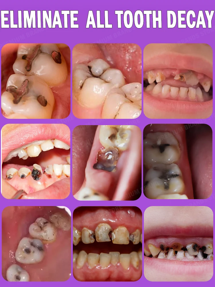 Decay tooth Cavities healing anti caries