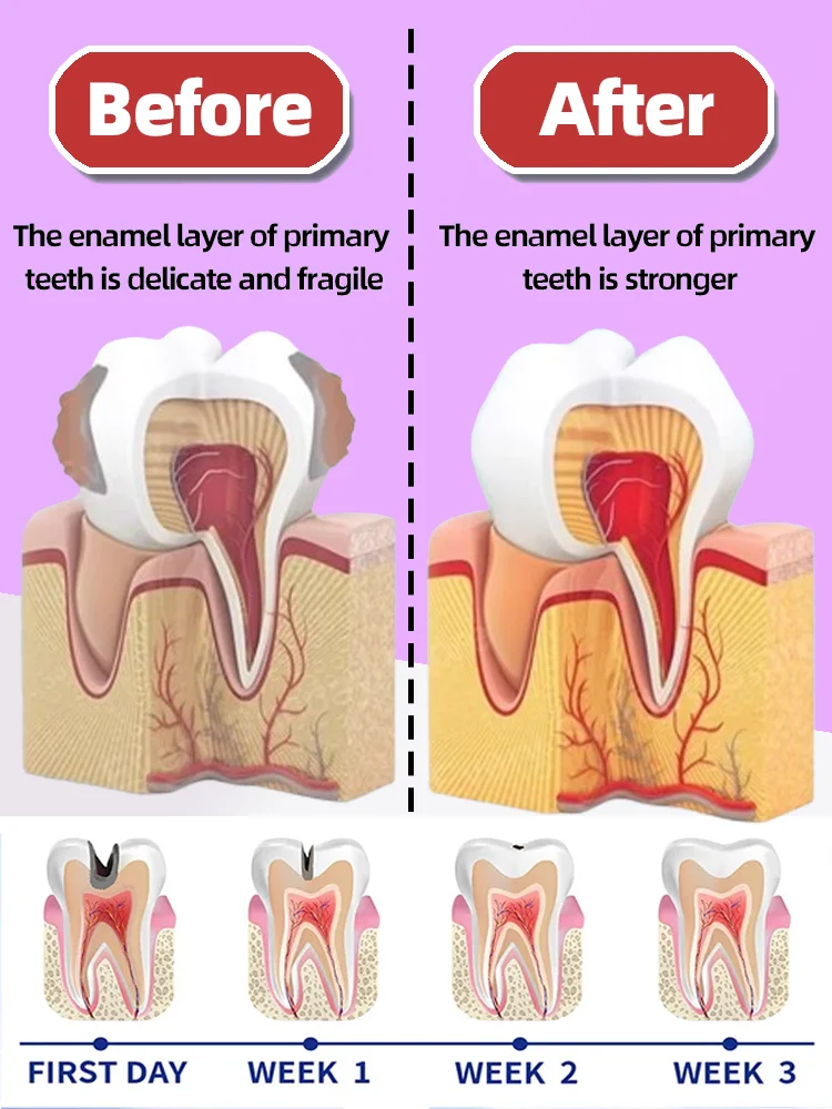 Traitement anti-carie des gencives, réparation des caries dentaires, cavités de carie