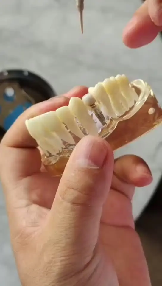 VV – pointe de détartreur dentaire ultrasonique, pour pièce à main EMS WOODPECKER-UDS pour le nettoyage des implants, prothèses dentaires orthodontiques en céramique