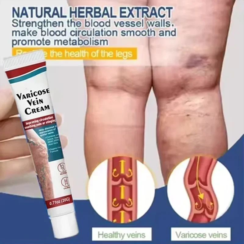 100%Original Vasculitis Blood Circulation Varicose Veins Treatment New Cream