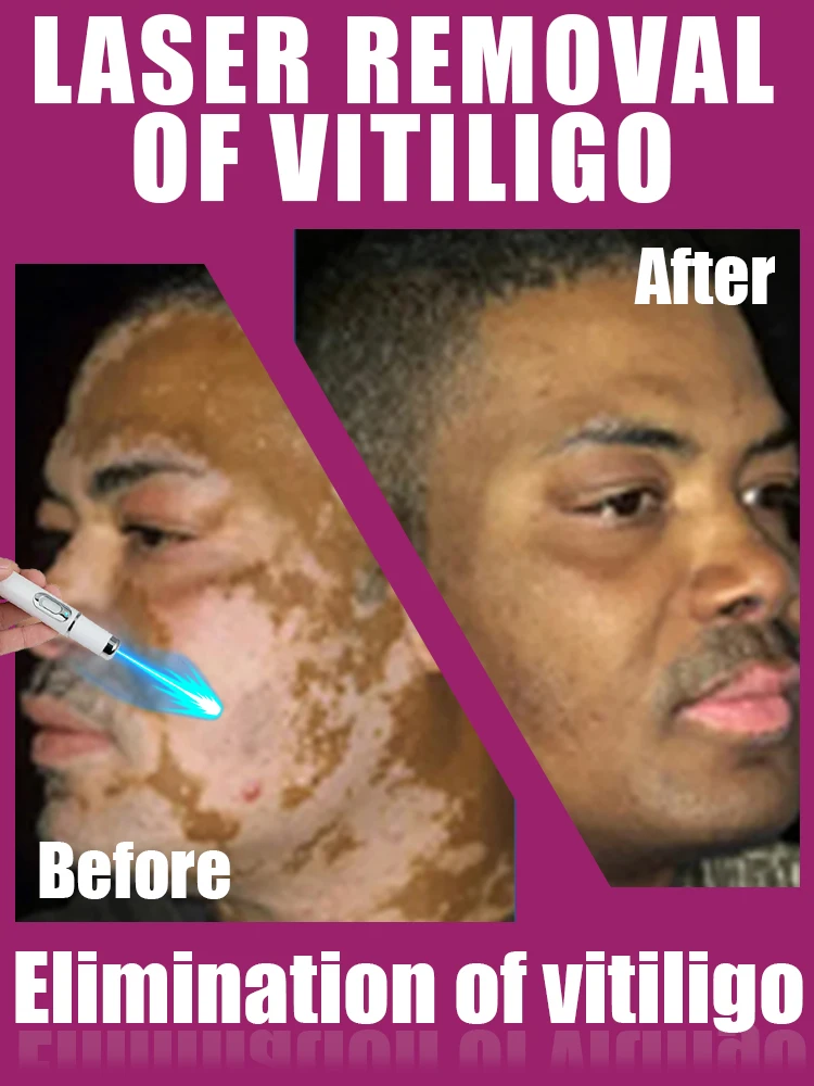 Vitiligo Pen Blue Light Laser