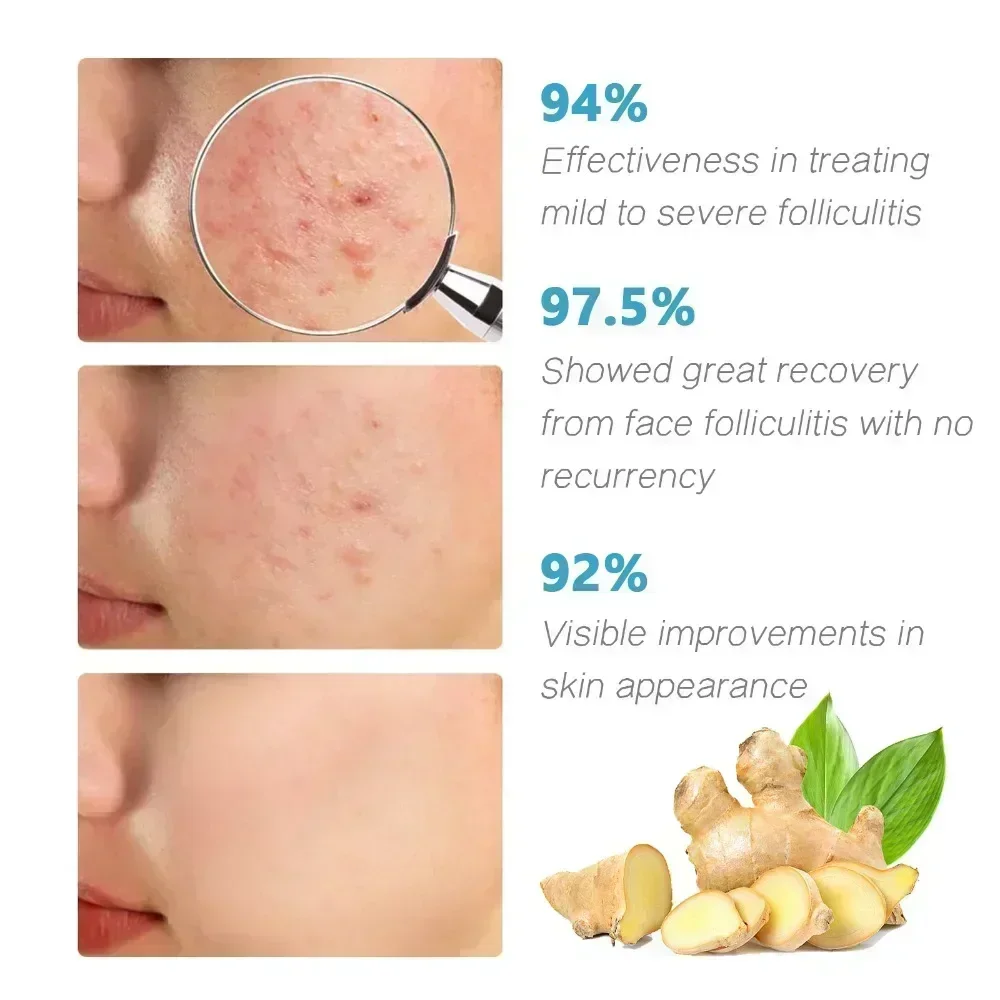 Anti-Acne Cream Effectively Removes Skin Nodules Pustules Cysts Papules Blackheads Men And Women Acne Skin Care Essence Cream