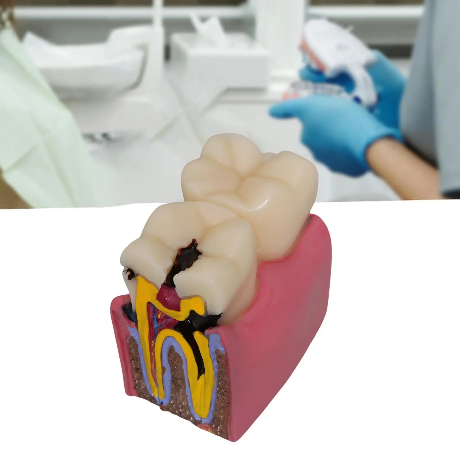 Caries Tooth Model 6 Times Teaching Prop Morphology, Resin ,Tooth Teaching Display for Studying Students Class Education Kids