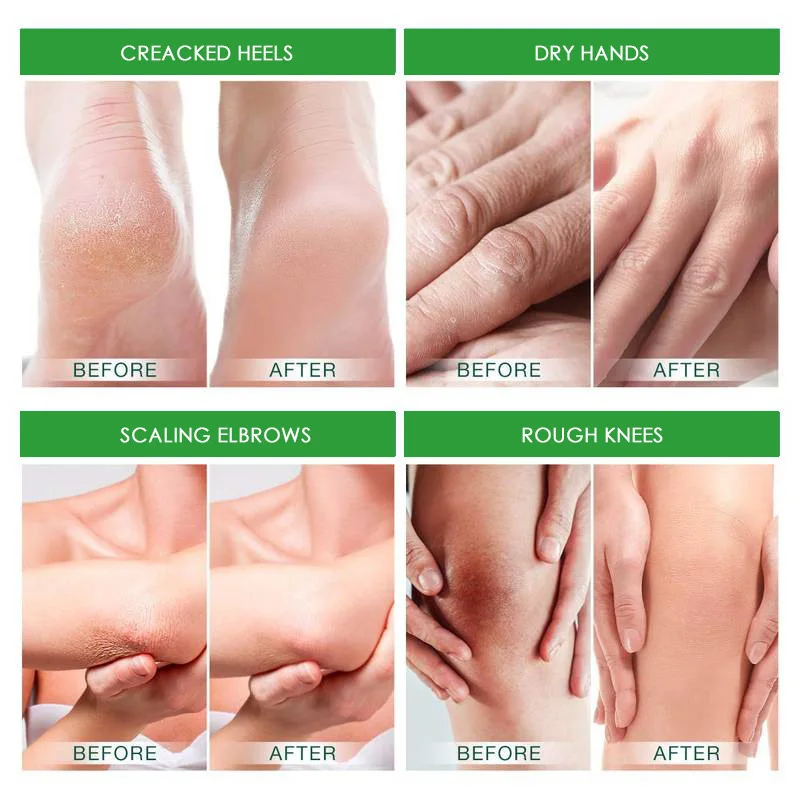 Herbal Anti Cracked Heel Treatment Cream Anti-Drying Removal Callus Dead Skin Balm Hand Foot Mositurizing Repair Skin Care Mask